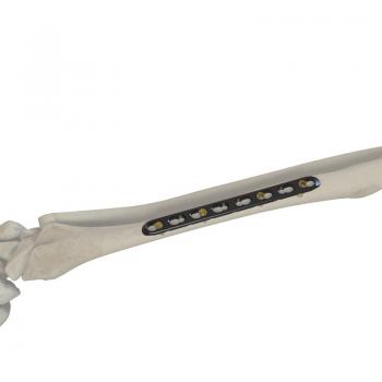 尺、橈骨鎖定接骨板